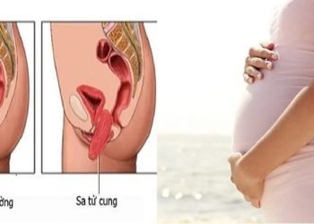 Cần làm gì nếu bị sa tử cung khi mang thai?