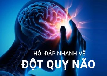 đột quỵ não