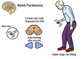Parkinson – chữa bằng đậu miêu và thuốc nam