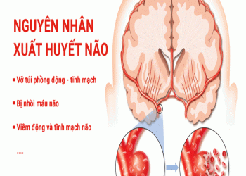 Tổng quan về bệnh xuất huyết não