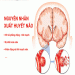 Tổng quan về bệnh xuất huyết não